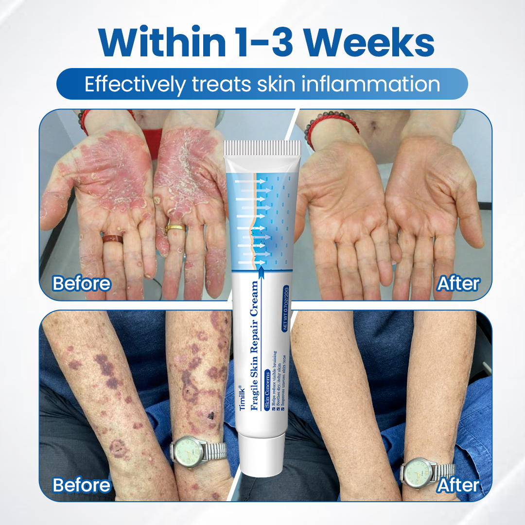 Timilk® Fragile Skin Repair Cream🛡️🌿 Multi-Repair for Bruises, Dryness & Spots