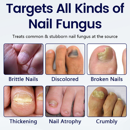 Timilk® Anti-Fungal Nail Repair Patch
