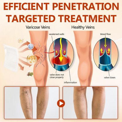 🔥 LIMITED SPECIAL OFFER🔥Timilk® VeinRepair Microneedle Patch Roll🦵✨ (Advanced Microneedle Vein Repair Patch for Bulging Veins, Swelling, Heavy Legs & Daily Leg Discomfort)