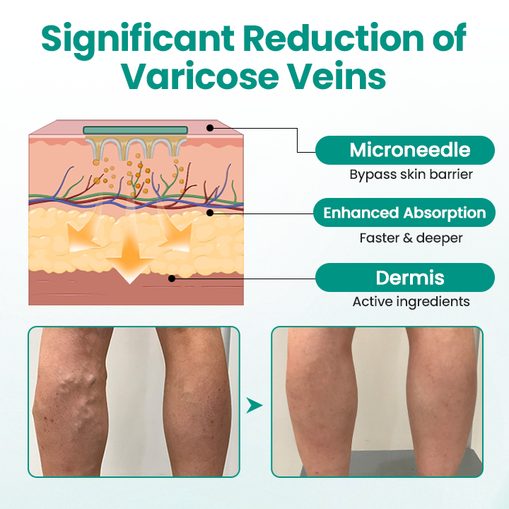 Timilk® LegRenew Varicose Veins Patch✨