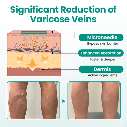 Timilk® LegRenew Varicose Veins Patch✨