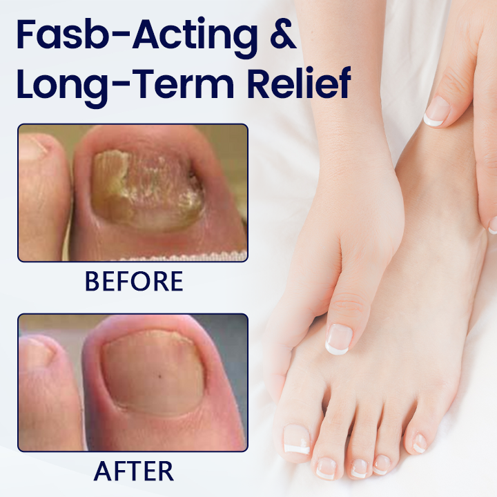 Timilk® Anti-Fungal Nail Repair Patch
