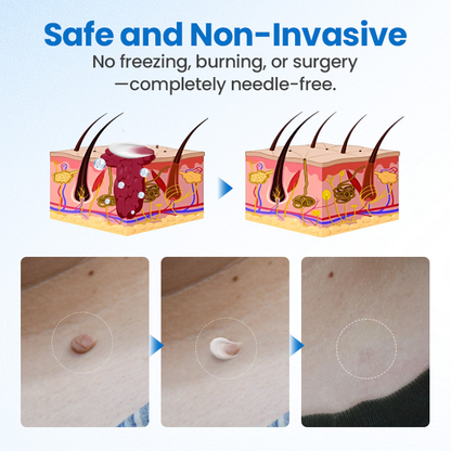 Timilk® TagGone Wart Removal Cream(KA)