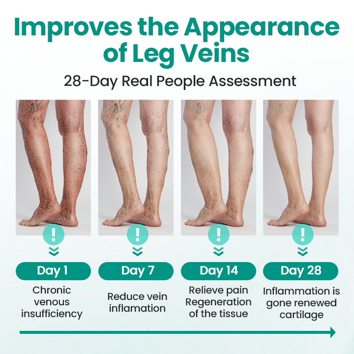 Timilk® LegRenew Varicose Veins Patch✨